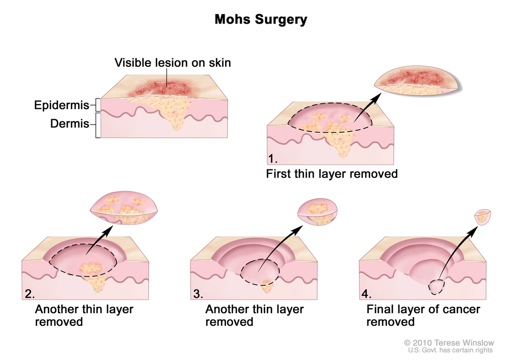 Psoriasis et cancer de la peau : Comprendre les risques et comment se protéger